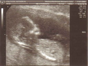 Baby Size on Ultrasound