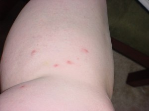 How big is a Bed Bug Bite