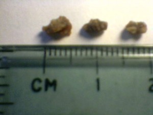 How Big are Kidney Stones?