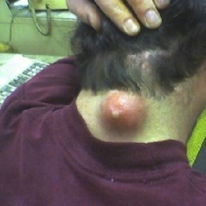 Worlds Largest Pimple